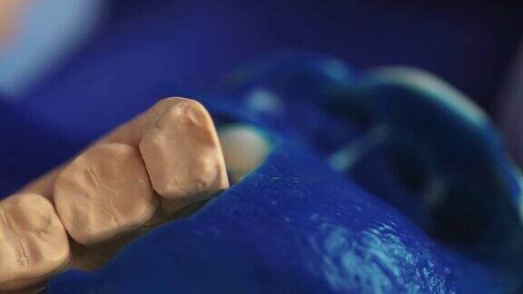 牙科中的雕刻塑料假牙牙科假肢3D扫描颌骨