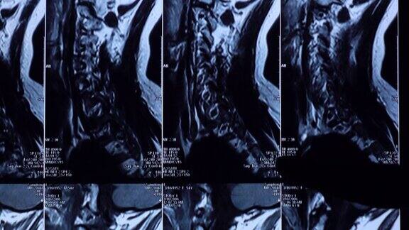 腰椎MRI检查片