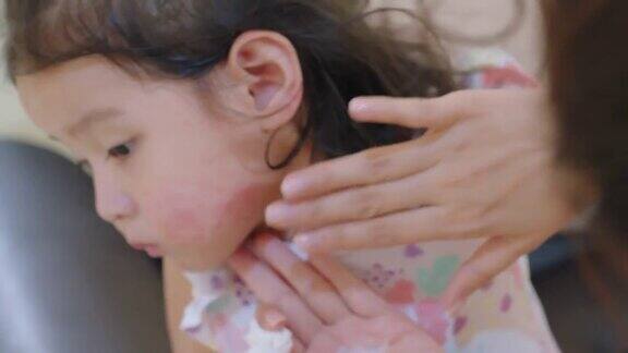 皮疹通常出现在蹒跚学步的女孩身上过敏孩子脸颊红肿