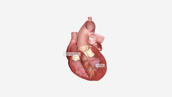 几种心脏疾病会导致心脏隔膜增厚