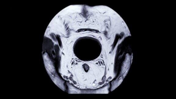老年男性前列腺MRI诊断前列腺癌细胞