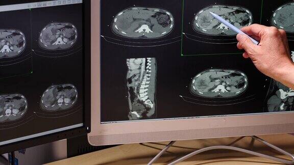 腹部CT扫描或计算机断层扫描
