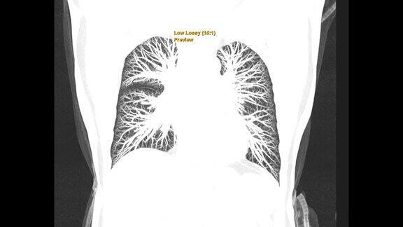 CT胸部或CT人胸部肺过滤技术冠状MIP视图诊断结核病、结核病和covid-19