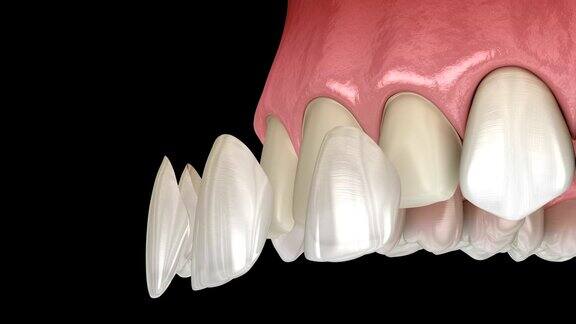 中切牙和侧切牙贴面安装程序医学上准确的牙齿3D动画