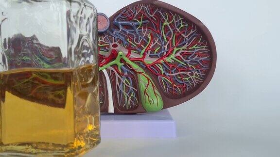 酒精性肝损伤和肝硬化