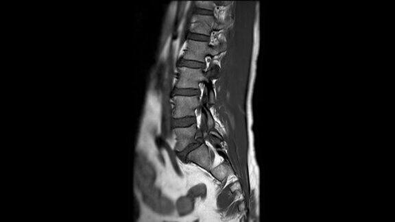 MRIL-S型脊柱或腰椎矢状T1W诊断脊髓压迫
