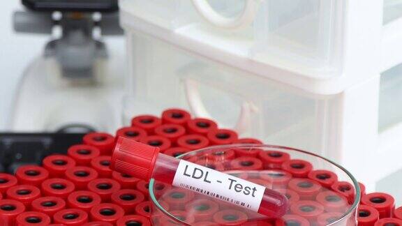 低密度脂蛋白测试从血液中寻找异常