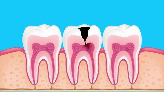 龋齿发展的各个阶段