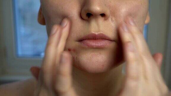 近距离观察皮肤问题(不健康的皮肤如痤疮和丘疹)治疗问题皮肤