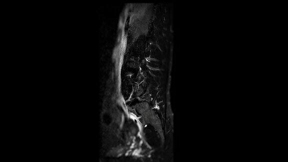 MRIL-S型脊柱或腰椎矢状位T2W脂肪抑制诊断脊髓压迫