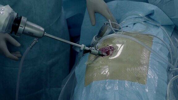 腹腔镜下的腹部手术