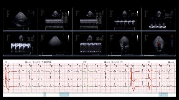 在数字平板电脑上检查心脏经胸超声心动图屏幕