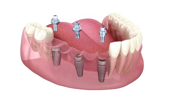基于3个种植体的牙桥医学上精确的人类牙齿和假牙的三维动画概念