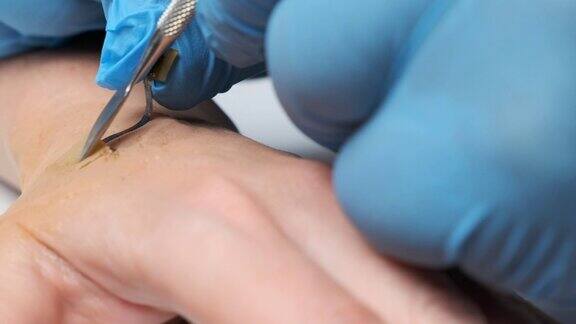 植入芯片微芯片被植入人手上的皮肤下