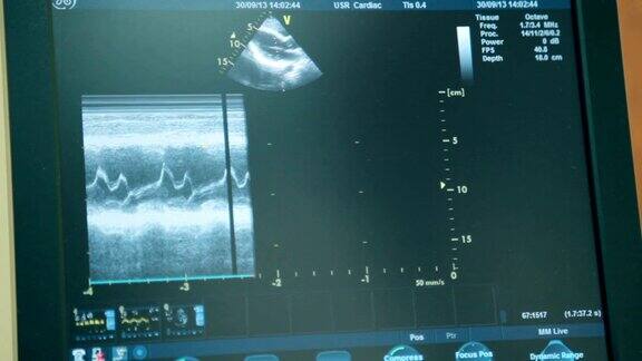 图像在一个医疗超声波机器的监视器上