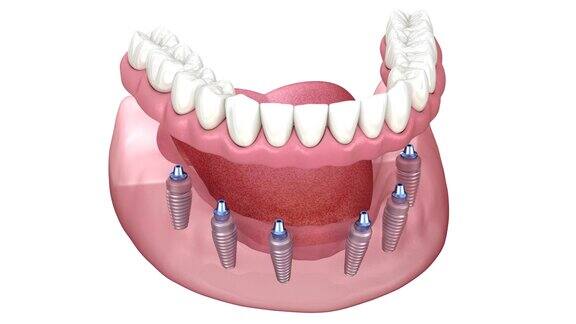 下颌假体与牙龈Allon6系统支持种植体医学上精确的人类牙齿和假牙的三维动画概念