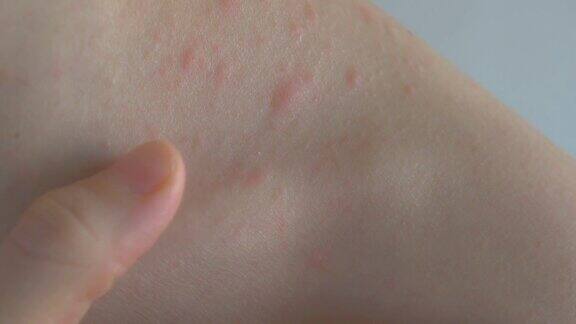 一根手指慢慢地划过皮肤表面接触发炎的皮肤皮肤上有大小不一的炎症面部和颈部有皮疹过敏性皮炎特写镜头
