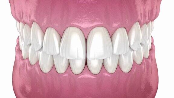 牙位异常矫正过程医学精确牙科3D动画