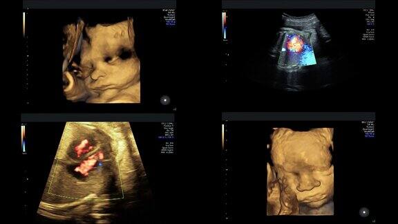 孕29周时对同卵双胞胎的超声检查