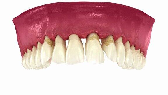 牙周炎和牙龈萎缩牙齿脱落牙科3D动画