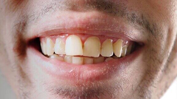特写镜头男人微笑着露出他那弯曲的黄牙牙科保健概念