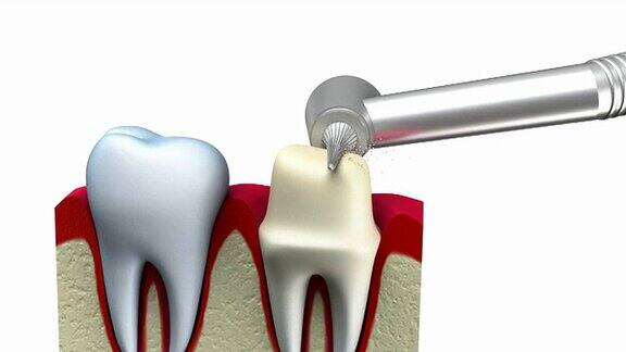 牙冠安装过程
