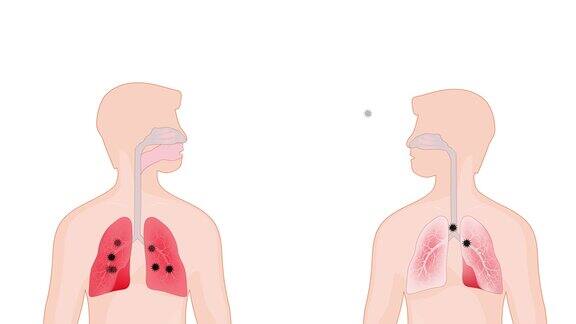 病毒人与人之间传播病毒的污染冠状病毒在肺
