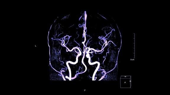 MRA大脑或磁共振血管造影在屏幕上从右向左旋转以评估大脑动脉疾病