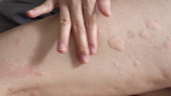 妇女适用于皮疹荨麻疹或过敏的身体