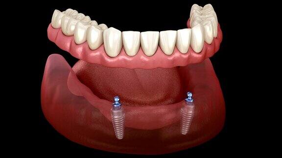下颌可移动假体全部在2个系统支持种植体与球附件医学精确牙科3D动画