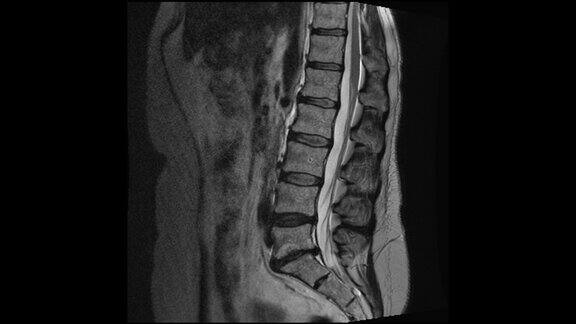 MRI显示L5-S1椎间盘突出