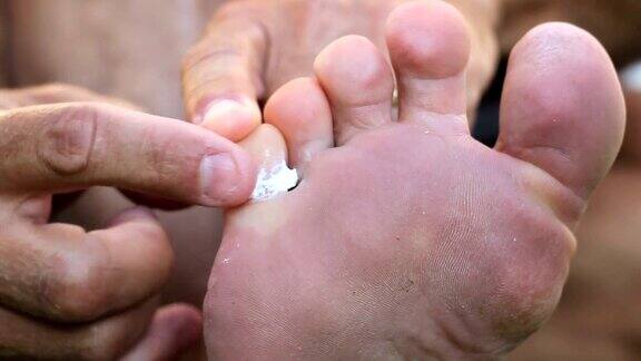男子为运动员脚部真菌涂抹特殊药膏