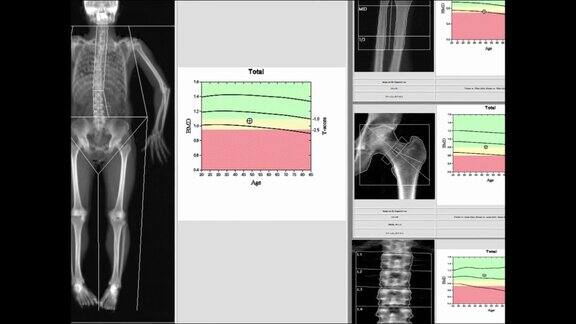 特别检查手腕、臀部和脊柱的骨密度当以全分辨率观看时图像太过模糊和人工合成