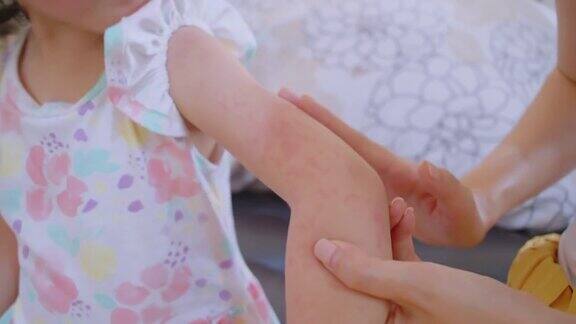 孩子的手臂上出现了皮疹