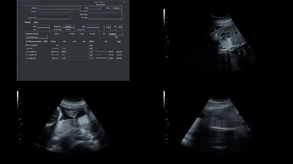 超音波显示25周时同卵双胞胎的心跳