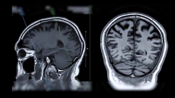 脑MRI比较矢状面和冠状面对痴呆患者海马的诊断作用