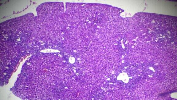 光镜下急性普通肝炎肝活检