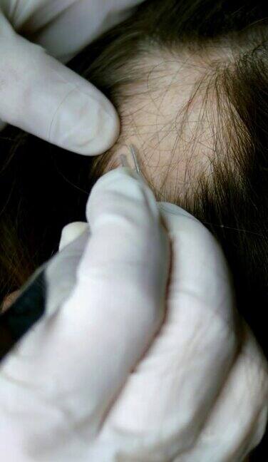 女人脱发医生或美容师做检查做程序没有头发的女人皮肤的头