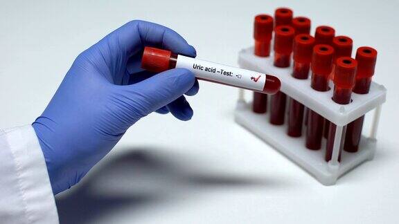 尿酸测试呈阳性医生出示血样实验室研究健康检查