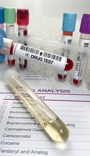 手医生拿着尿管和血管测试来分析兴奋剂或药物