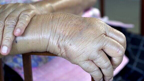 老年人手肿胀或手浮肿
