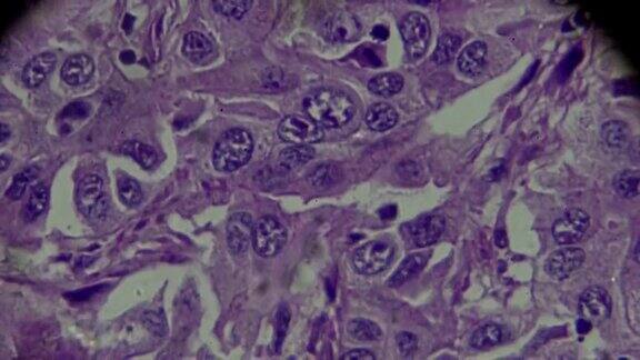 肝细胞癌显微镜下的HCC