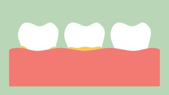 牙龈炎或牙龈疾病前牙龈上的菌斑