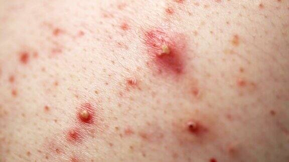 皮肤问题极近距离的皮肤痤疮和丘疹