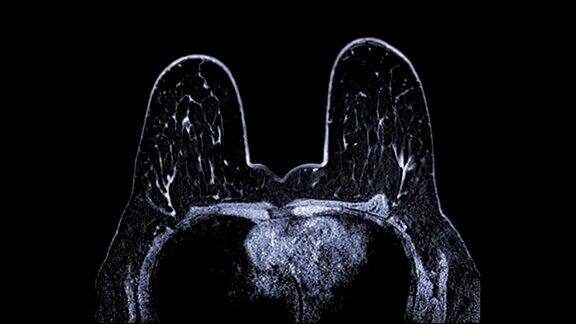 乳房磁共振成像或MRI乳房筛查乳腺癌轴位T2检查