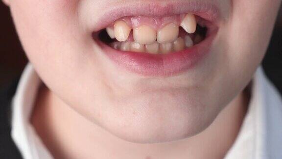 一个男孩的脸部特写他的牙齿长得不正常儿童口腔和牙齿的问题