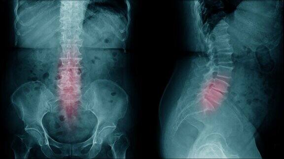 腰椎病的背痛x光片