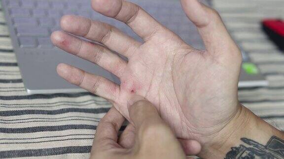 亚洲男子感到发痒和抓挠他的手医疗保健疤痕