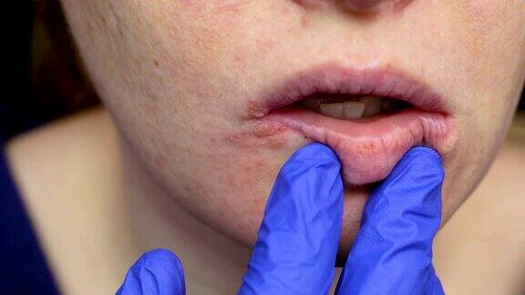 唇疱疹:一名女性感冒并感染了疱疹病毒皮肤科医生和传染病专家对她进行了检查