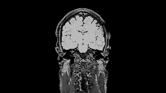 MRI脑部扫描对大脑进行磁共振成像